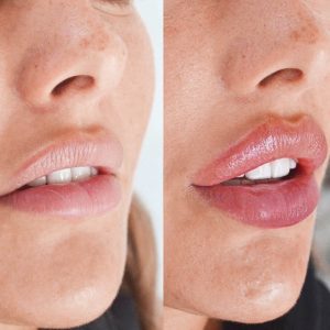 Pretty Kiss Lip Filler