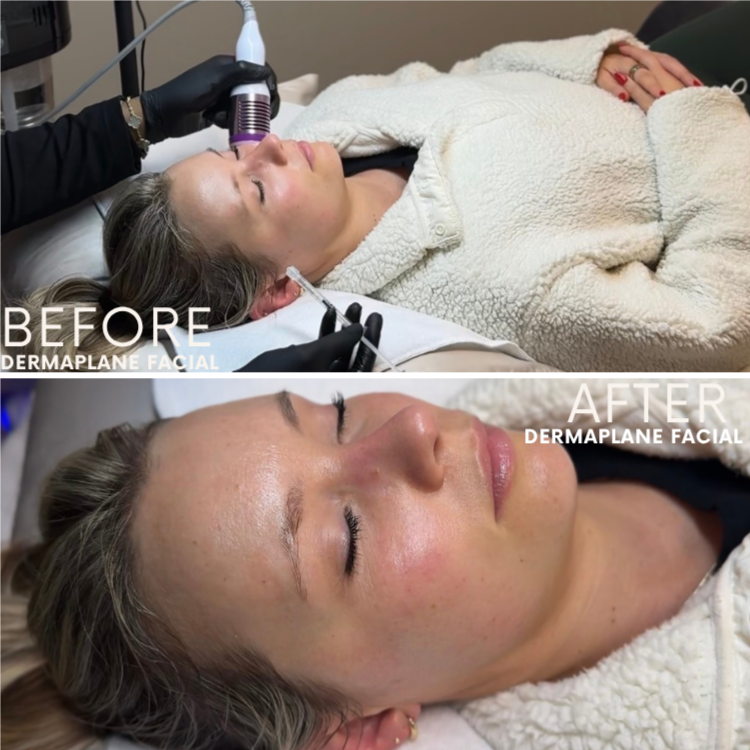Dermaplane Facial at Glow Aesthetics Studio in Atlanta, GA