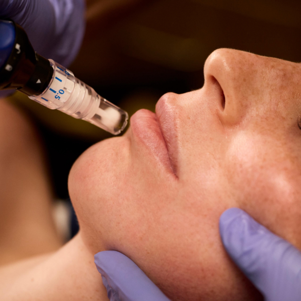 SkinPen Microneedling at BellaFace in Excelsior, MN