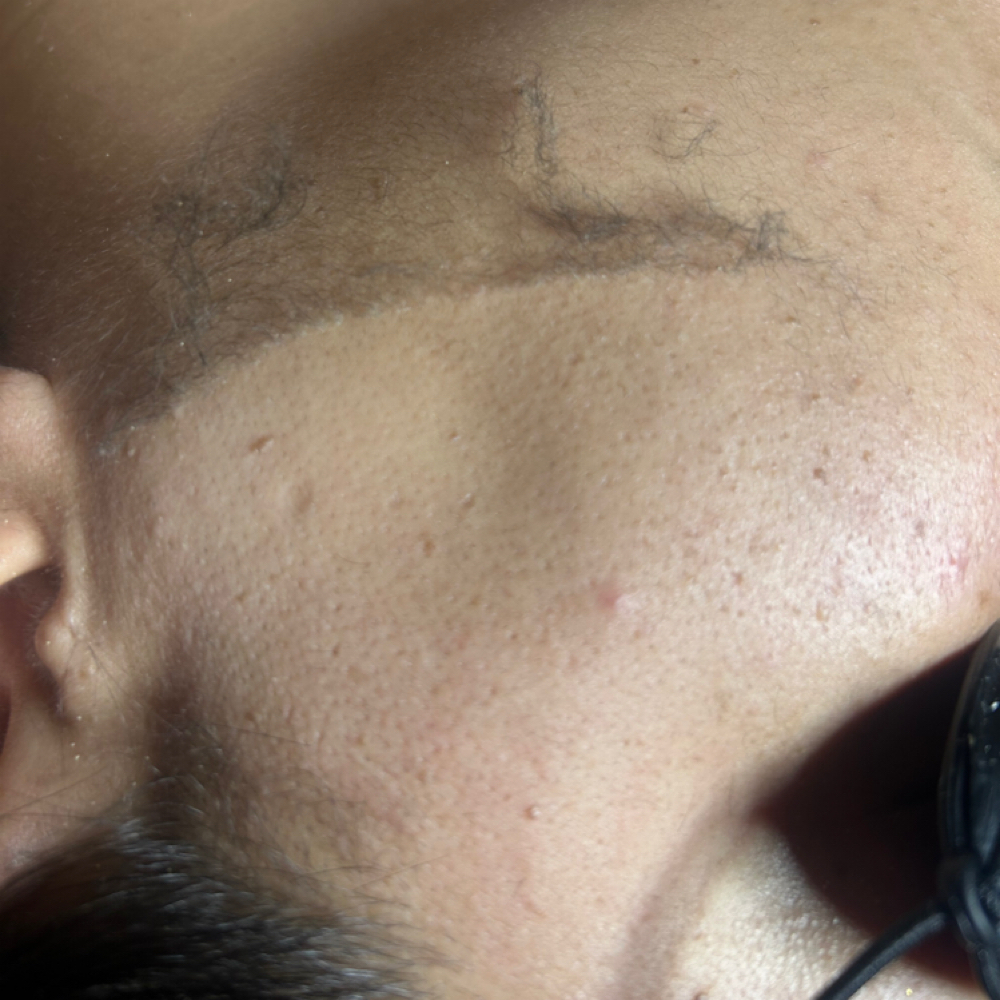 Dermaplane Facial at First Street Oasis in Temple, TX