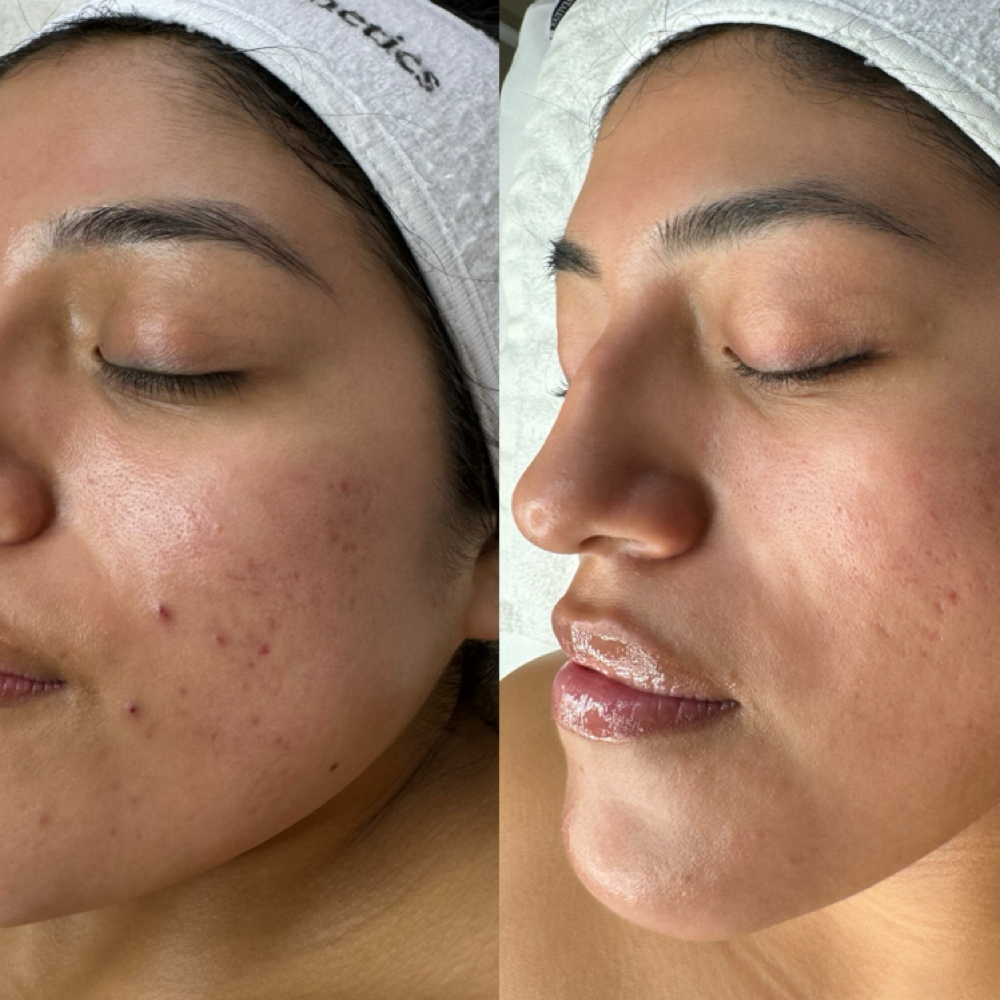 TCA Light Chemical Peel at Oasiah Aesthetics in New York, NY