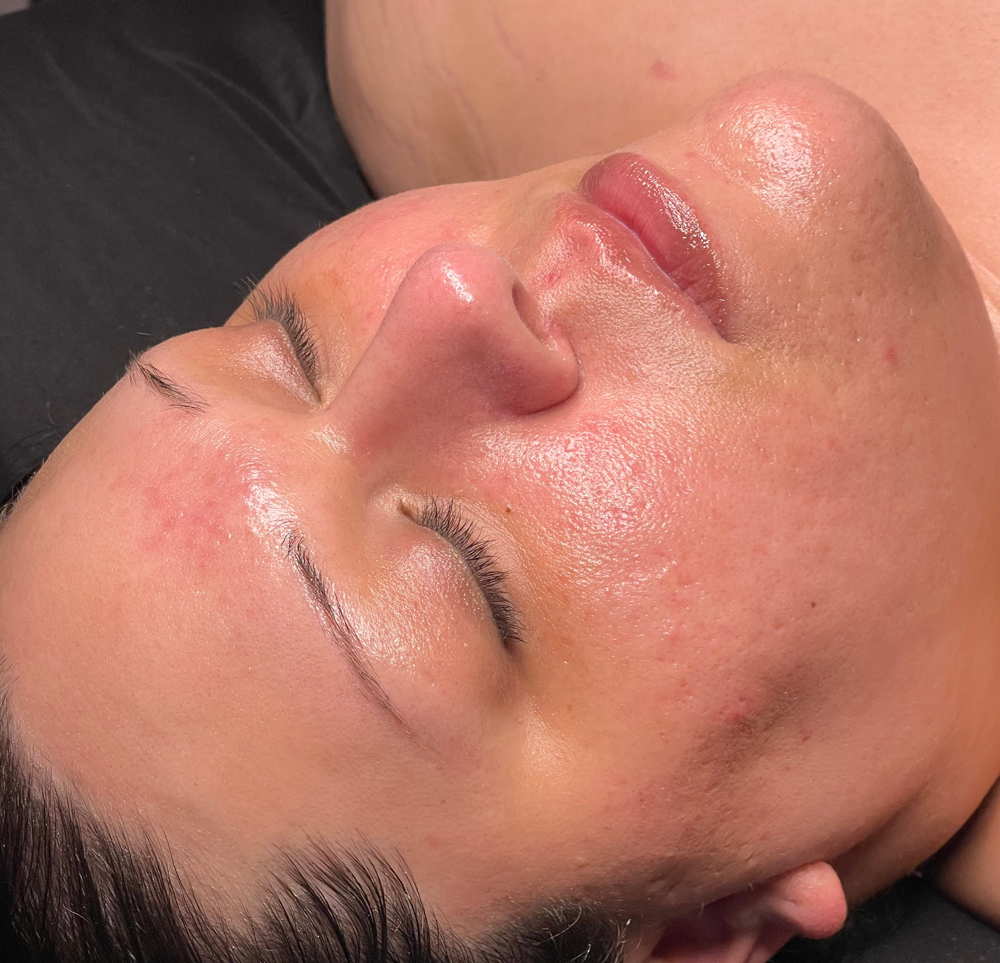 Skin Peel Facial