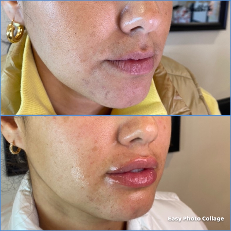 Lip filler 1.5 ML