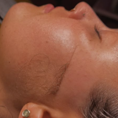Dermaplane Treatment at Nikki Blake Esthetics in Grand Rapids, MI