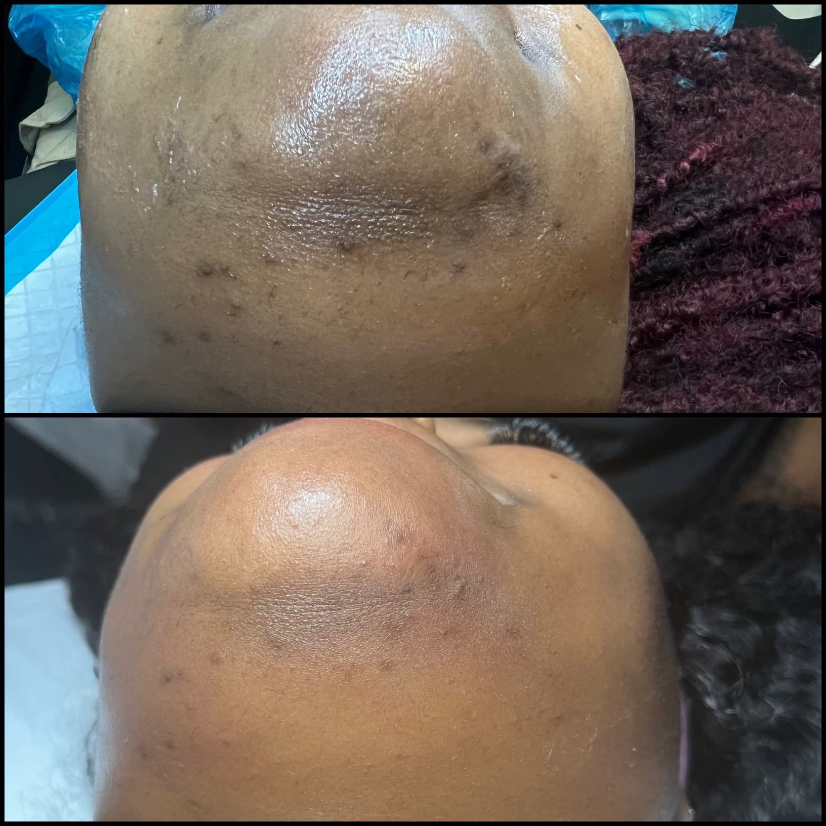 INGROWN TREATMENT - ONLY