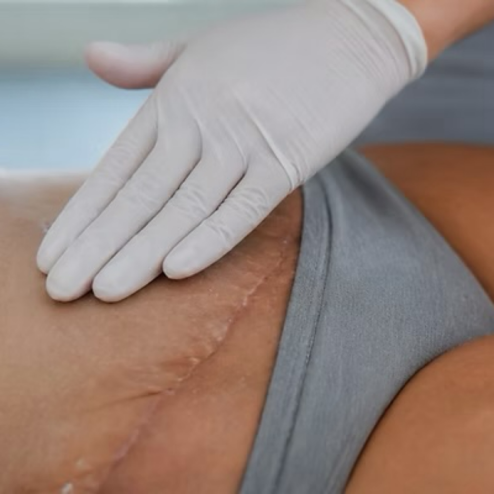Post Surgical MLD & Recovery Care at Andréa Prather, LMT, MLD-C, CPST in San Angelo, TX