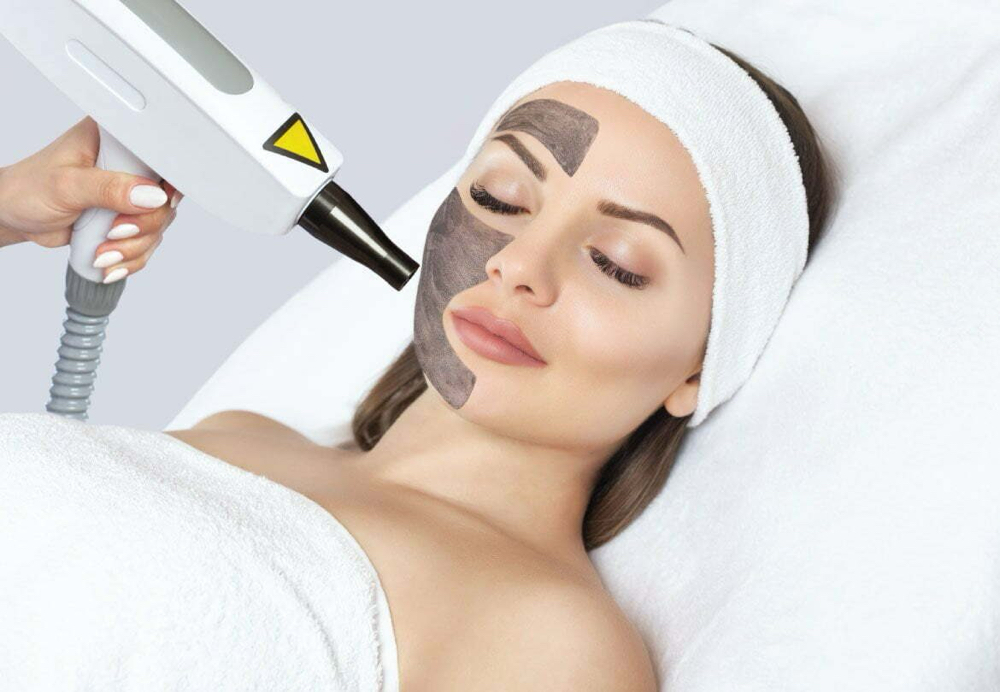 Carbon Peel