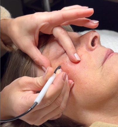 ThermoClear Treatment