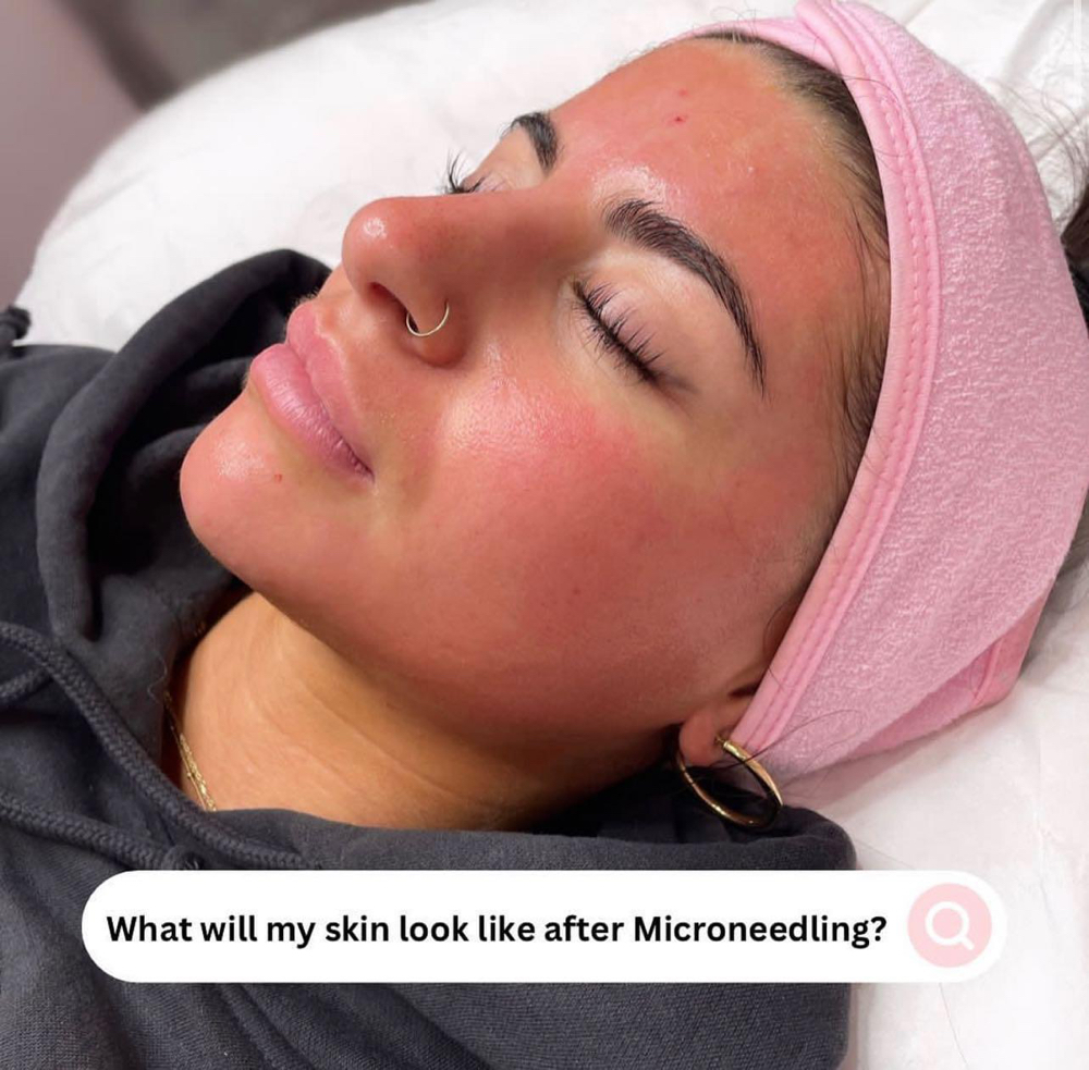 Microneedling