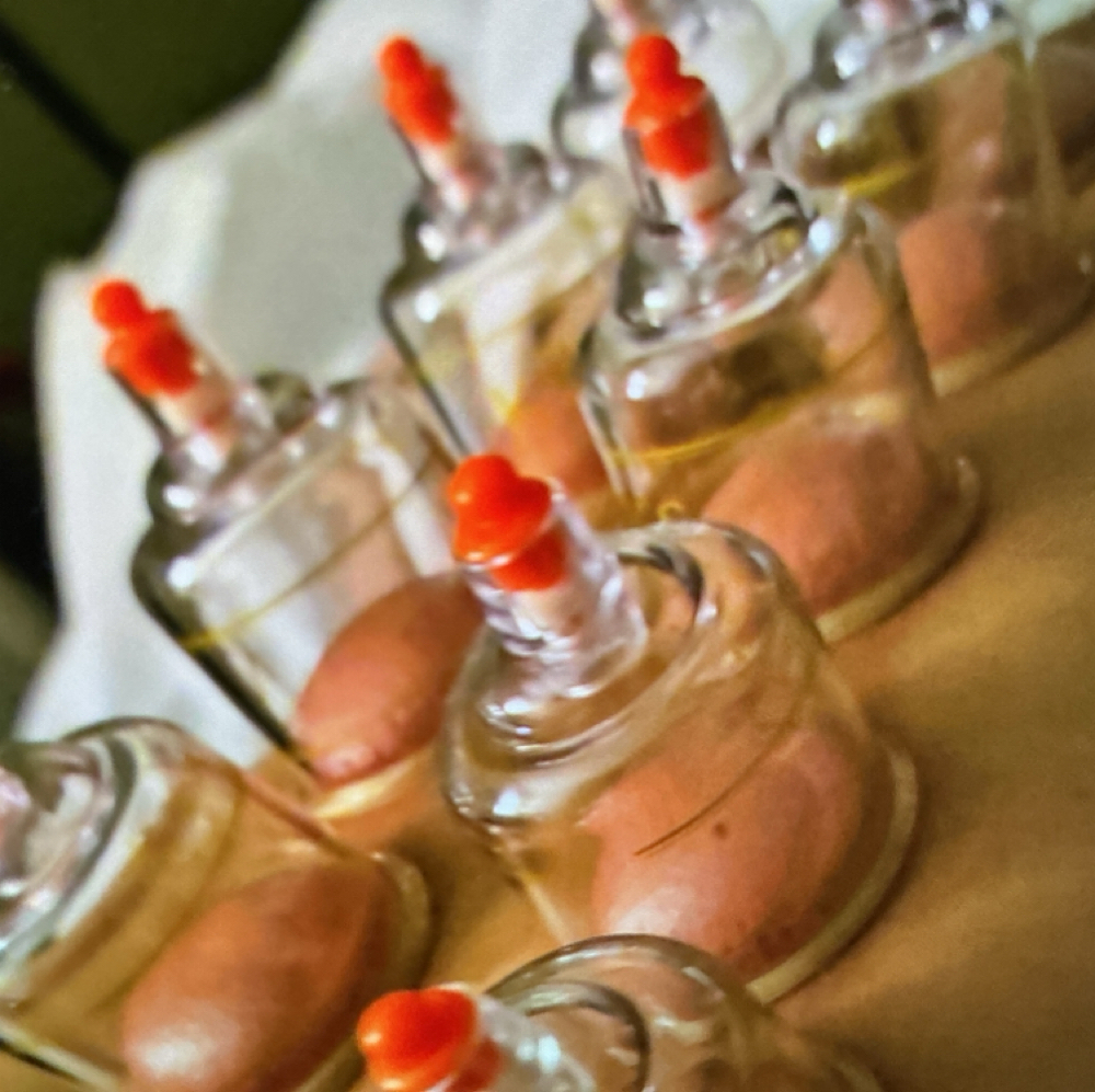 2 Hours Cupping at Valencia Muscular Therapy in San Antonio, TX