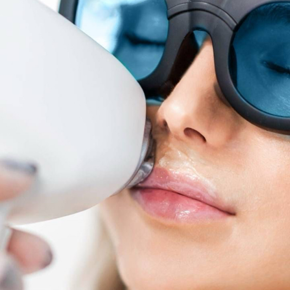 Laser Hair Removal - Upperlip at Radiance Beauty Studio in McAllen, TX