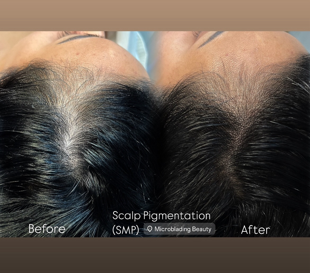 SMP ( Scalp Pigmentation