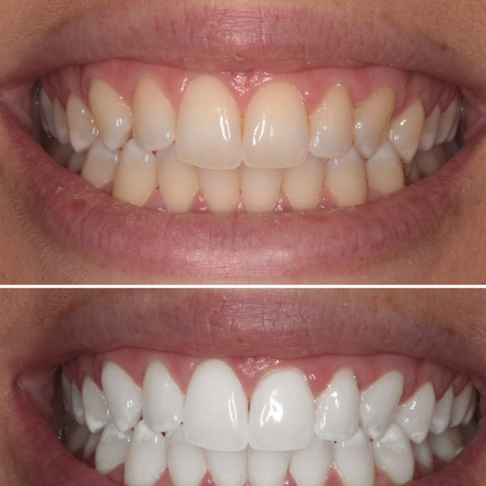 Teeth Whitening 120min at Heavenly aesthetic studio in Bronx, NY