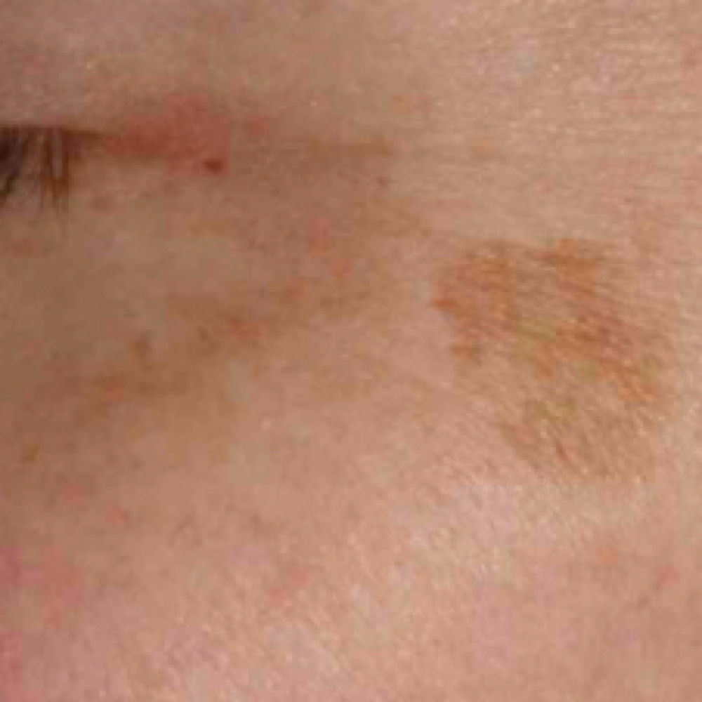 Hyper Pigmentation Prot 6%  Retinol at Empower Aesthetics in Canyon Lake, TX