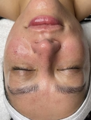 Dermaplane Facial