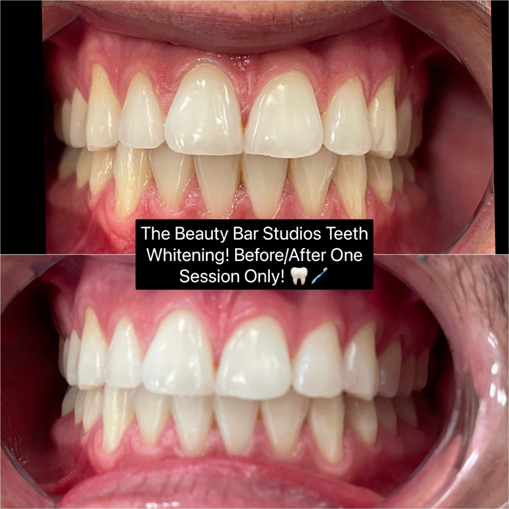 Cosmetic Teeth Whitening