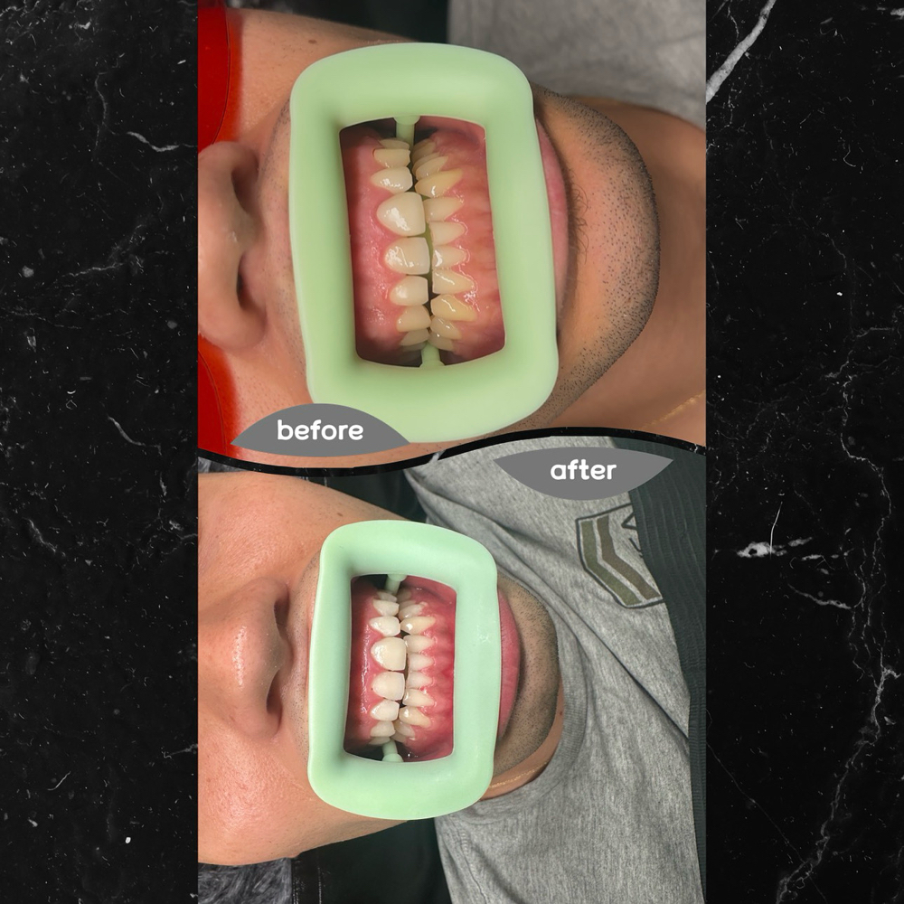 60 Minute Teeth Whitening