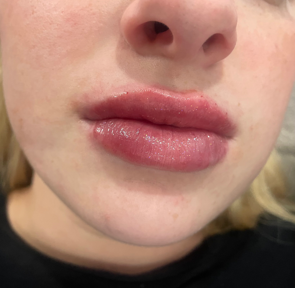 1ml Microneedle Lip Filler