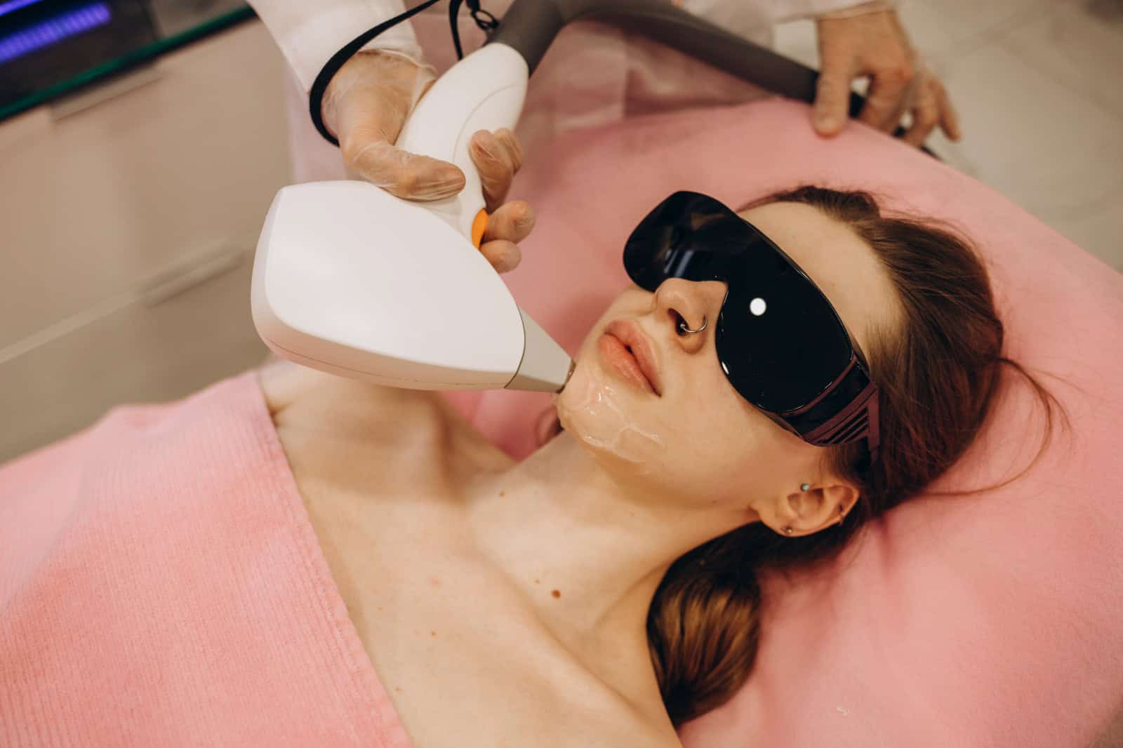 Laser Hair Removal: Chin