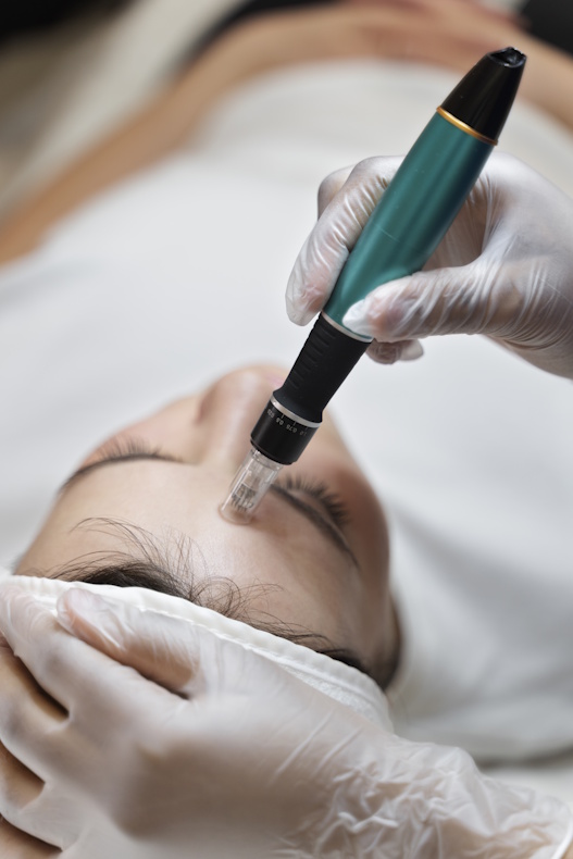 Microneedling Treatment