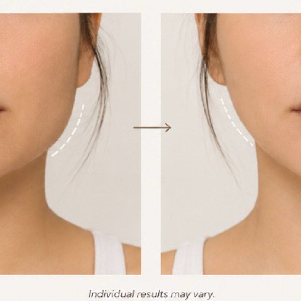 Jaw/ Masseter at SCL Aesthetics in Putnam, CT