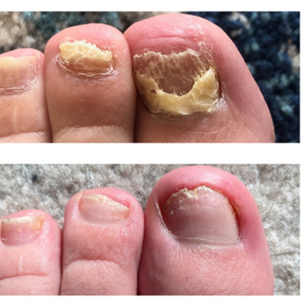 Nail Fungus Treatment at Southern Sparkle Medical Aesthetics in Swainsboro, GA