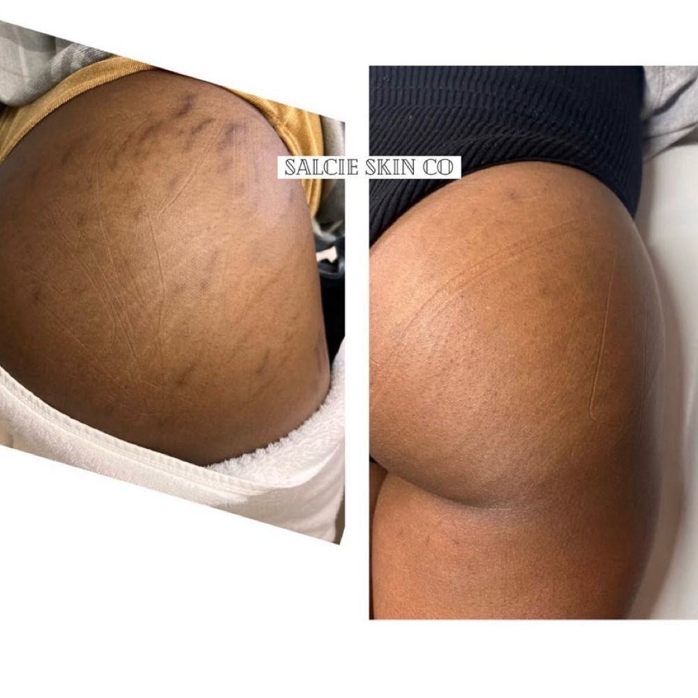 Inkless Stretchmark Micropuncture at SALCIE SKIN COMPANY in Raleigh, NC