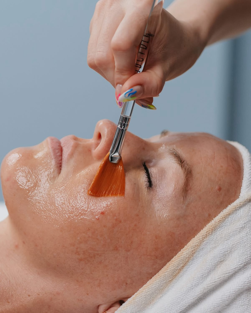 20% Salicylic Acid Peel