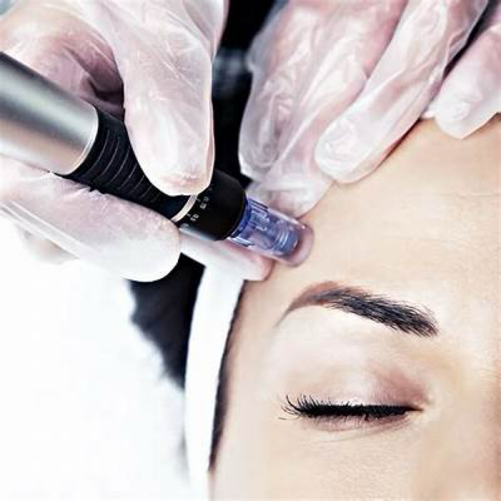 Skin Renewal Microneedling at Holdfast Beauty in Las Vegas, NV