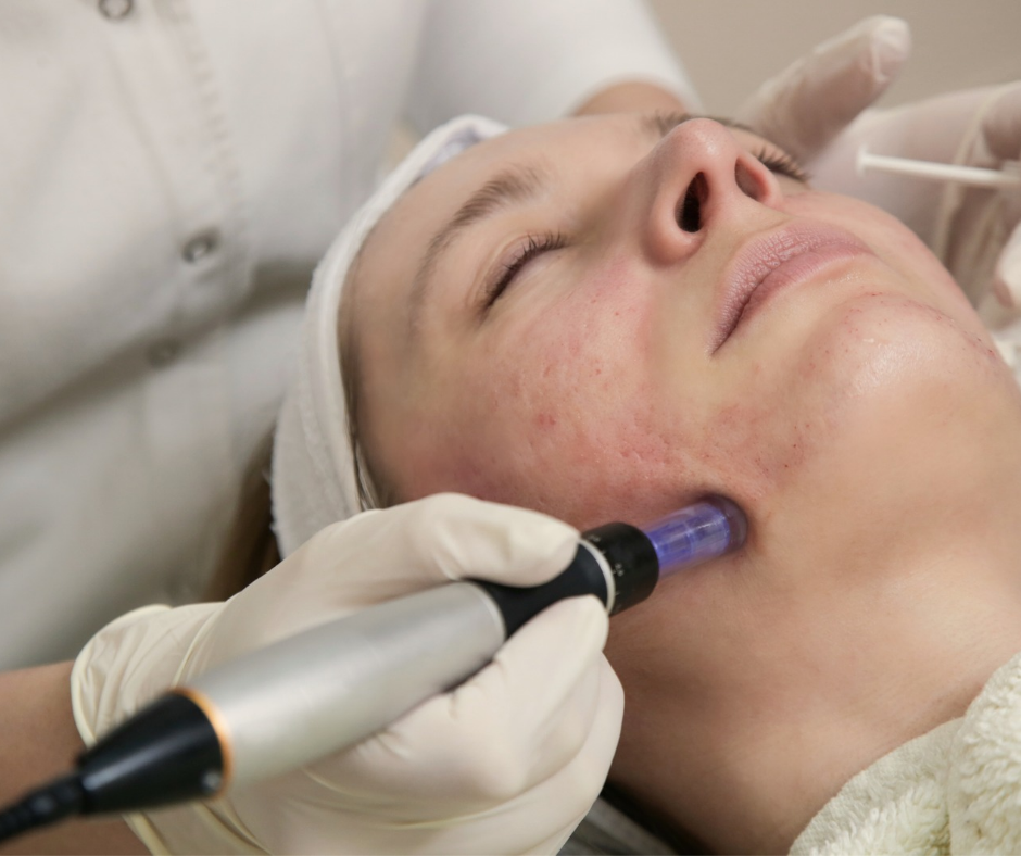 Microneedling