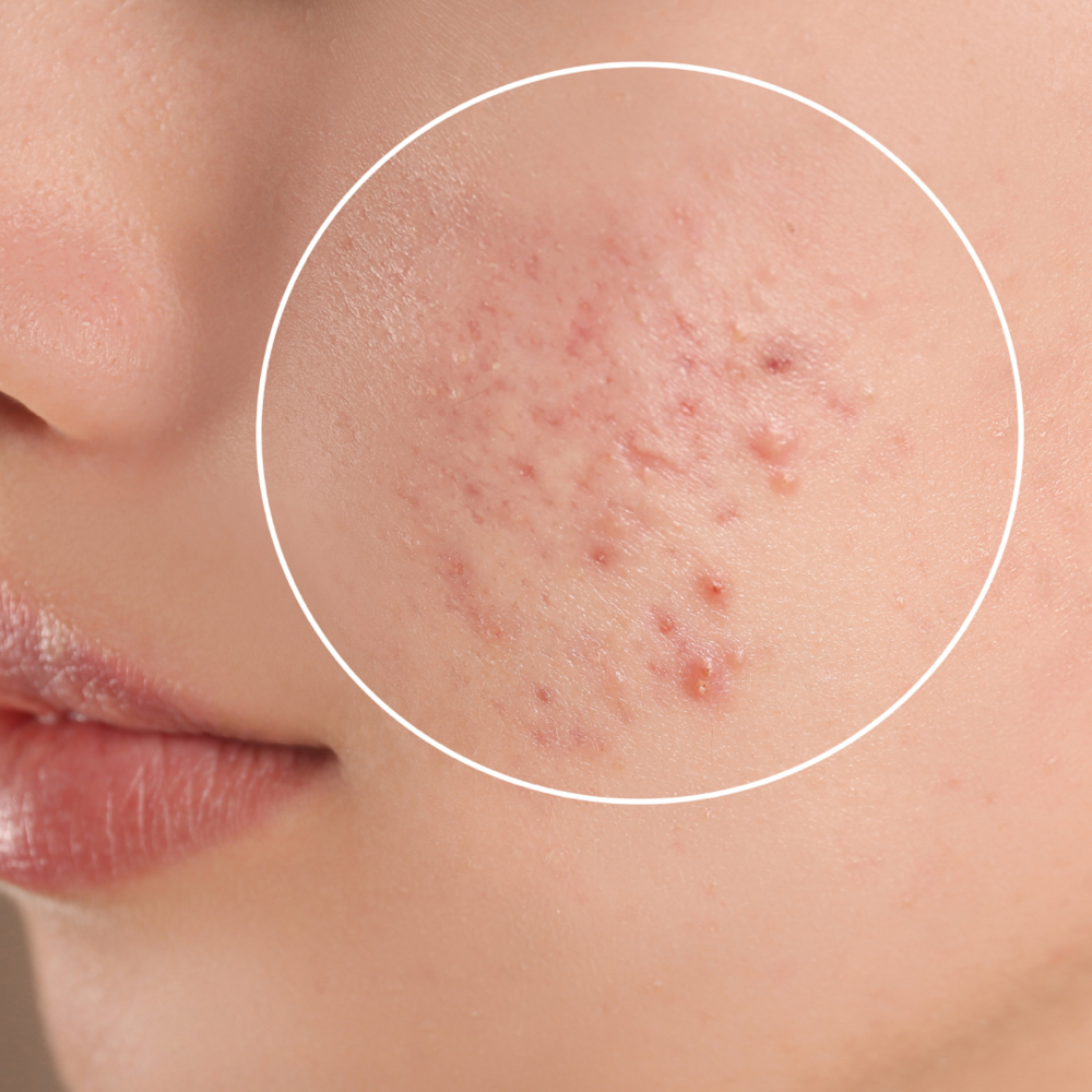 ACNE MANAGEMEN FACIAL