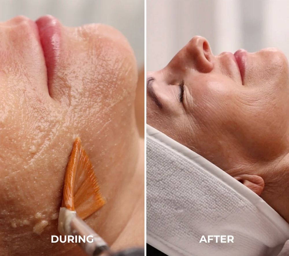 The Lux Lift Facial at Ashley W. | Skin Care in Venice, FL