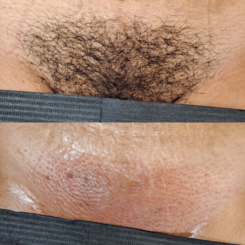 Brazilian Wax