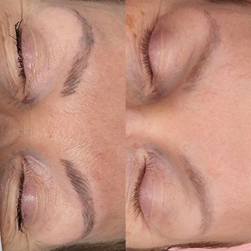 Saline Removal / Session
