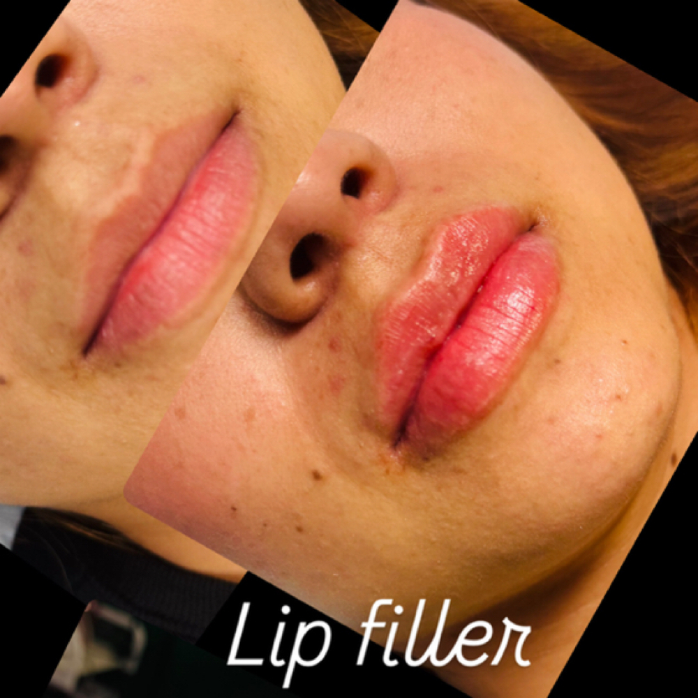LIP 👄 at Bella Esthetic and Spa  LLC in Cleveland, OH