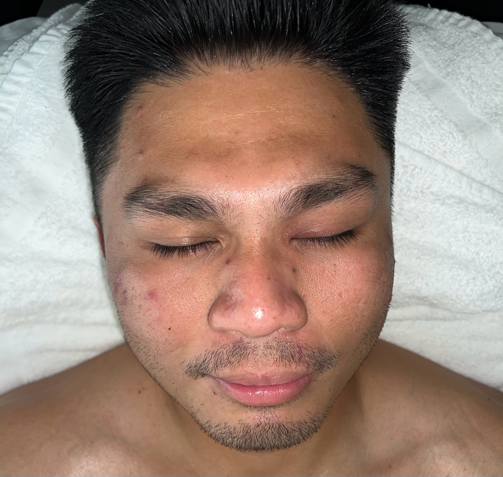 Acne Facial