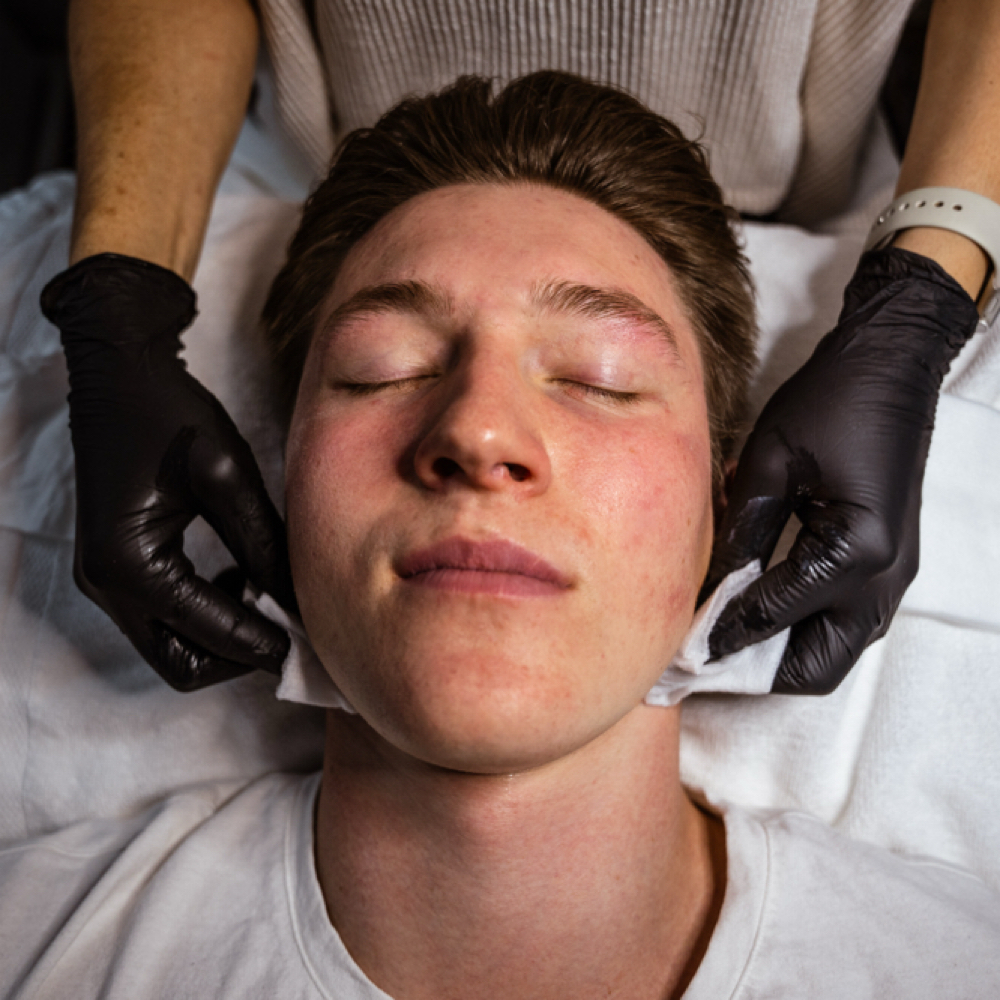 Acne Facial (First Time Guests) at Everbloom Skin in Arlington, WA