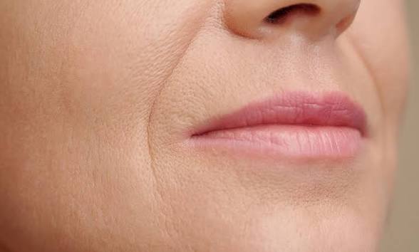 Nasal labial folds / smile lines at Natural Glow in Grand Praire, TX