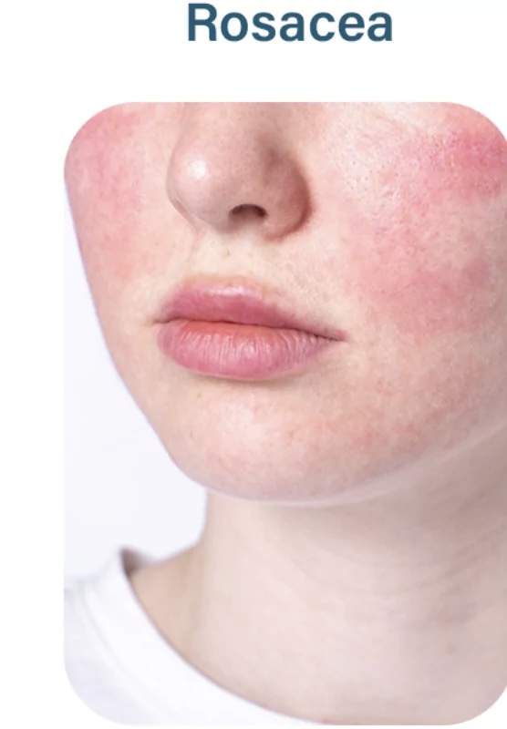 Rosacea Facial/Treatment