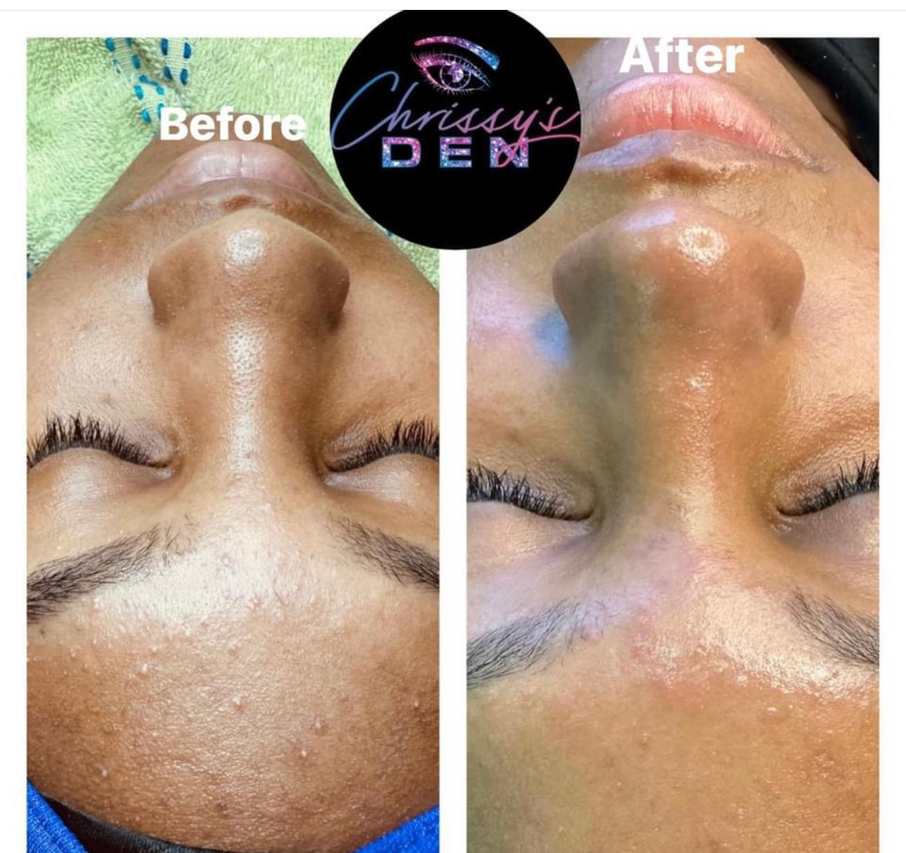 Dermaplaning Deluxe Facial