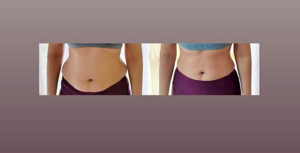 Lipo Shots at Bliss by criss llc in Buda, TX