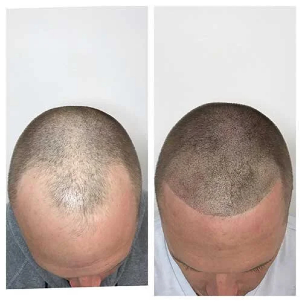 Full Scalp Micropigmentation