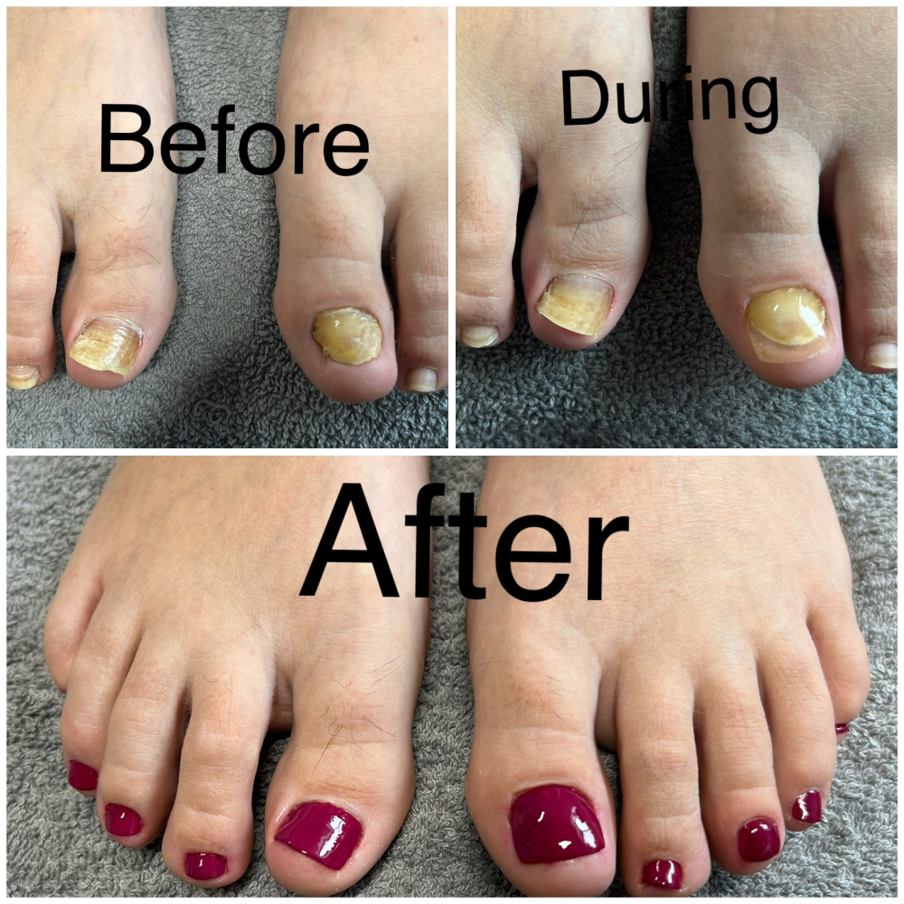 2 Big Toenails Restoration at Sole 2 Soul Spa in Wilmington, NC