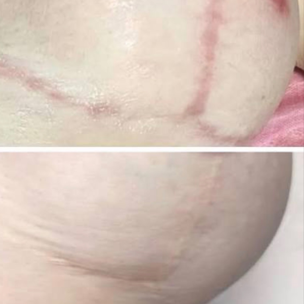 Scar Camouflage at Revive Skin by Ang in Downey, CA