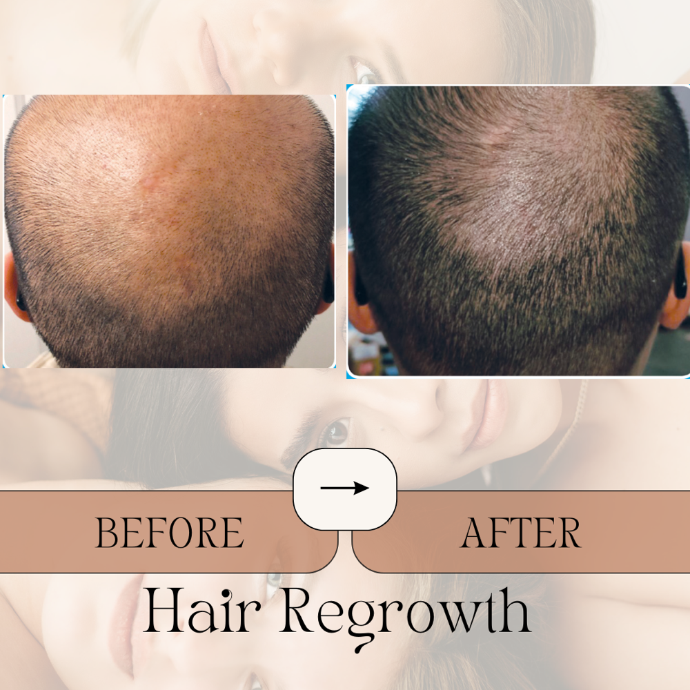 Hair Regrowth Treatment