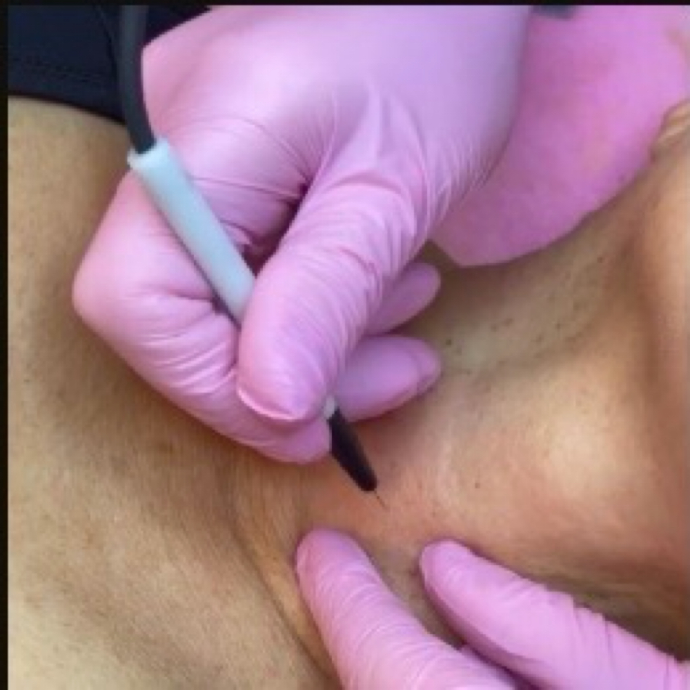 ✨ Lesion Removal Consultation at Tru U Esthetix in Franklin, TN