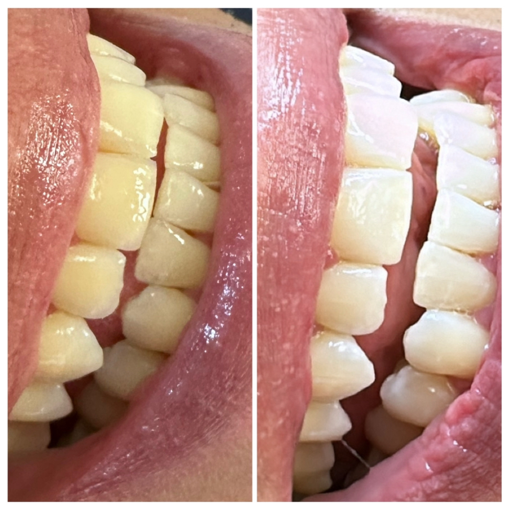 Teeth Whitening