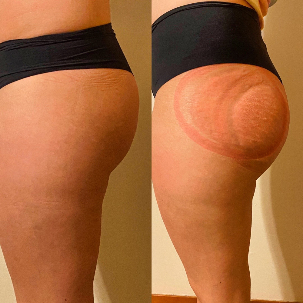 Bubble Butt Lift