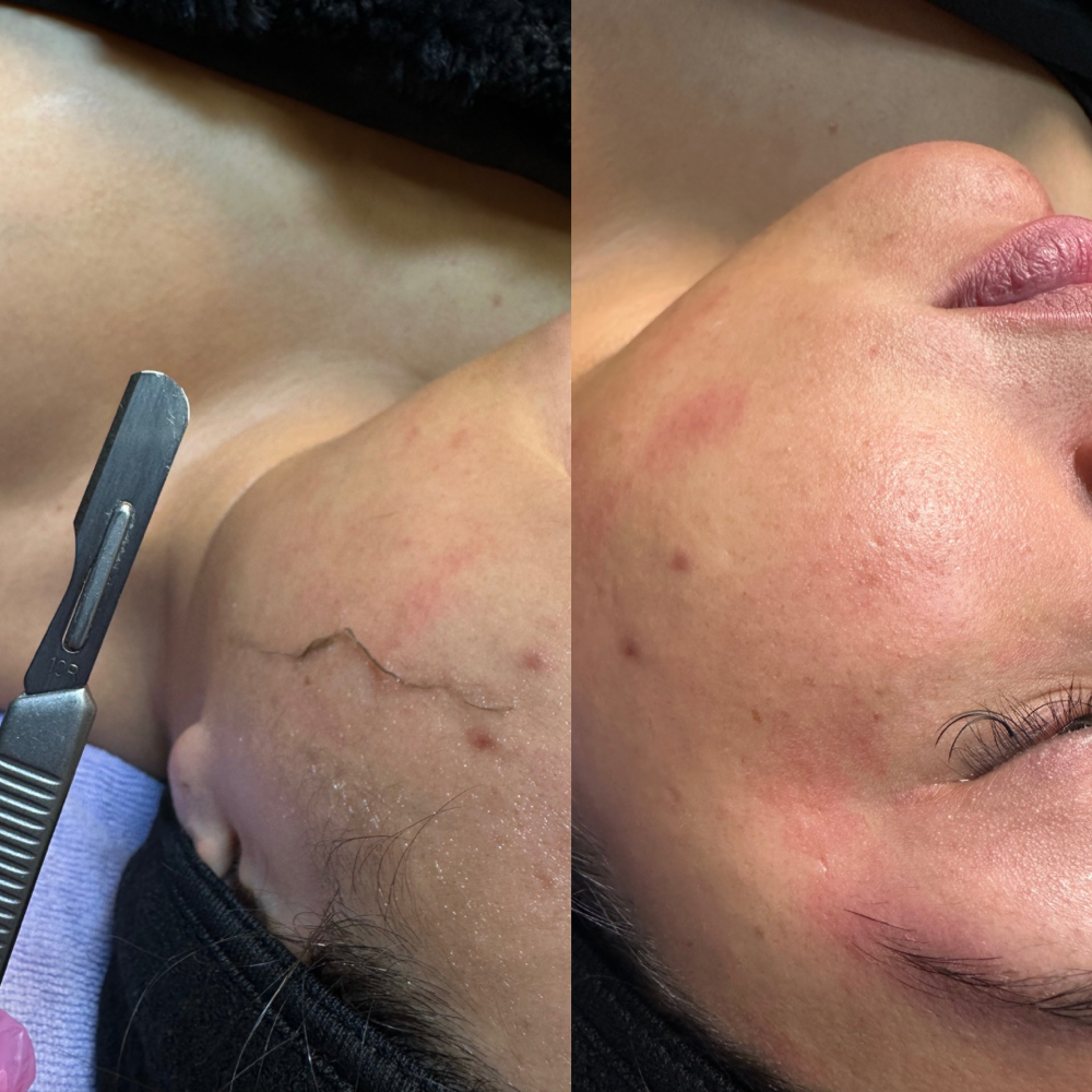 Dermaplaning Facial ✨