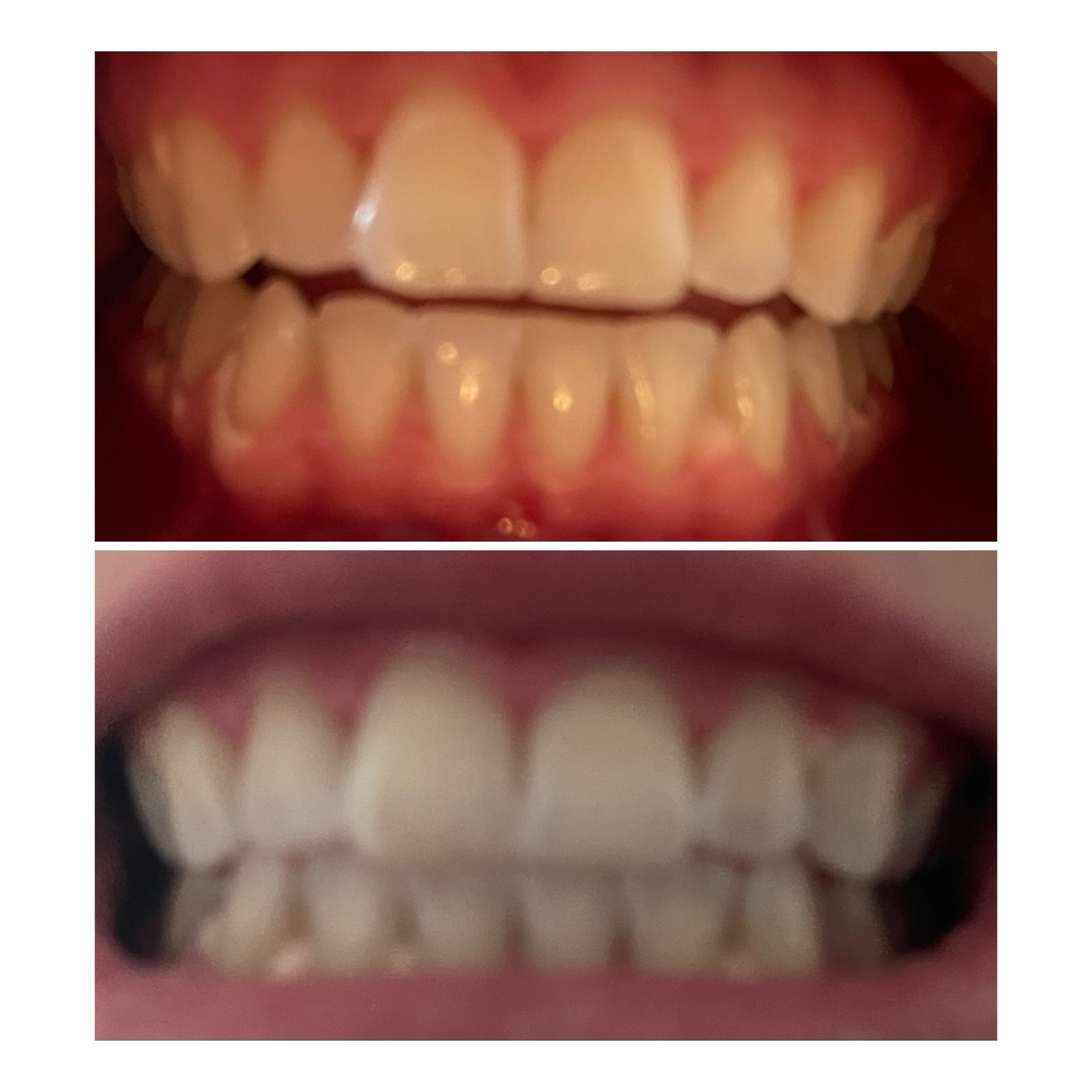 Teeth Whitening Session